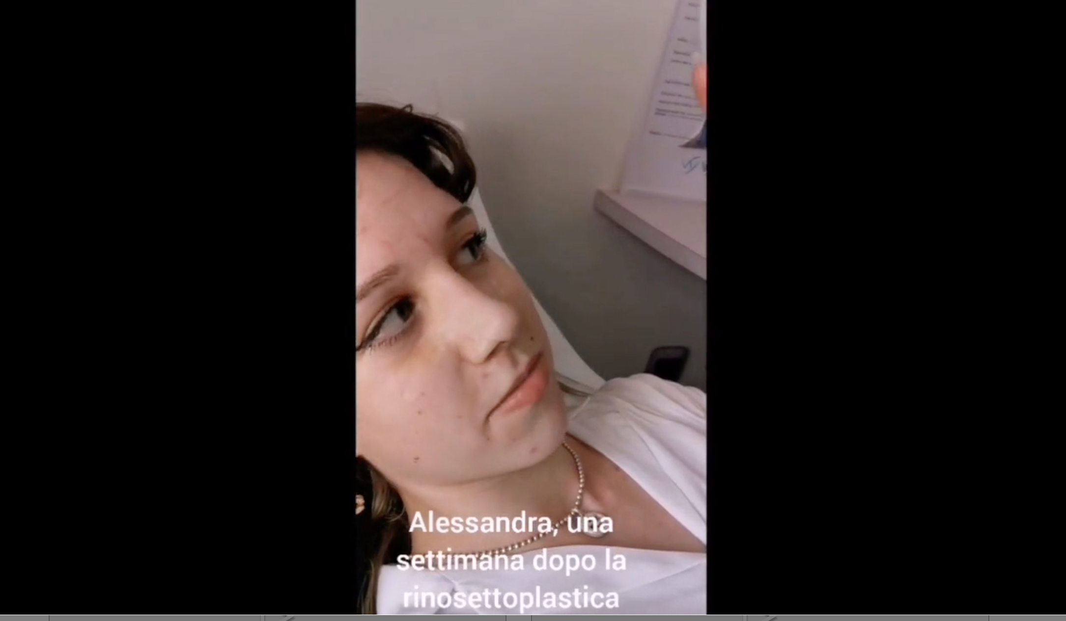 Alessandra una settimana dopo la rinosettoplastica